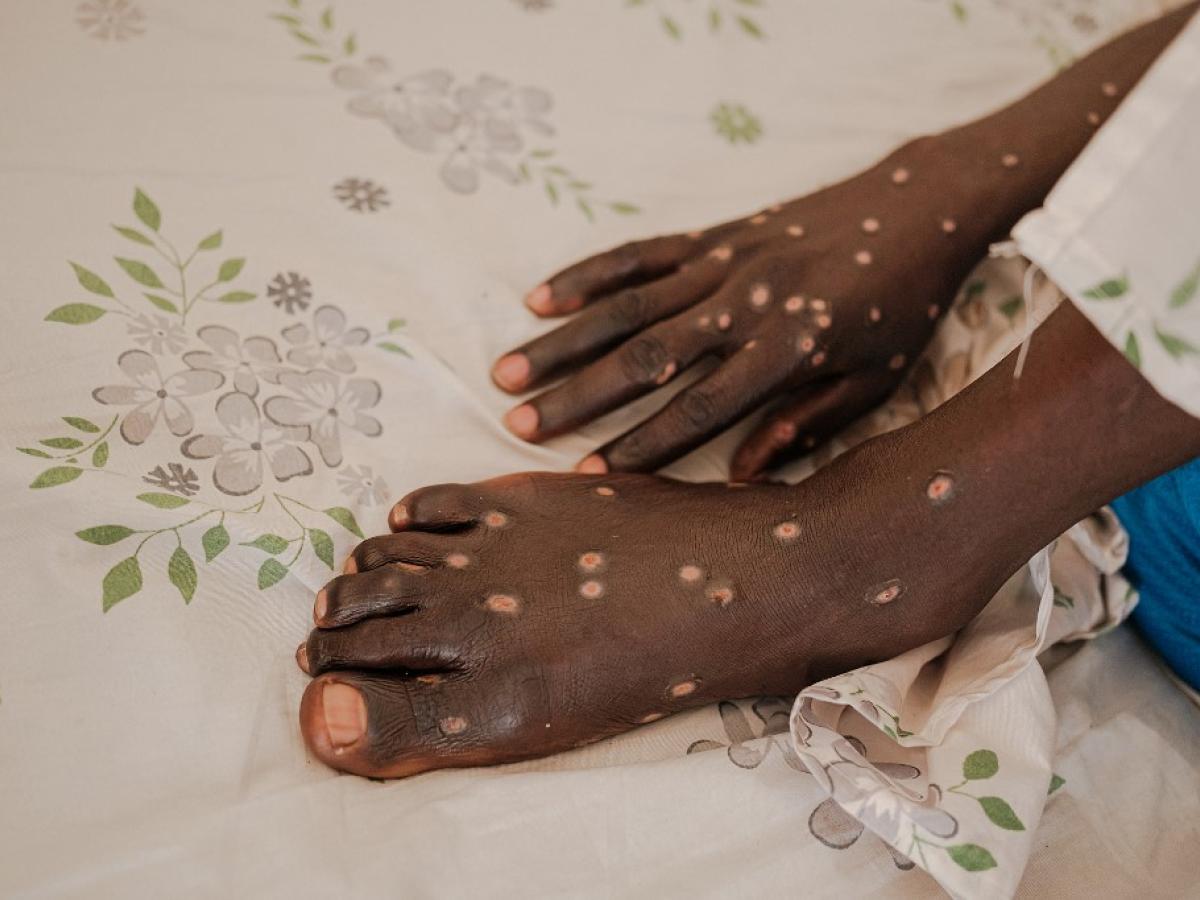 ¿Qué tan peligrosa es la mpox?