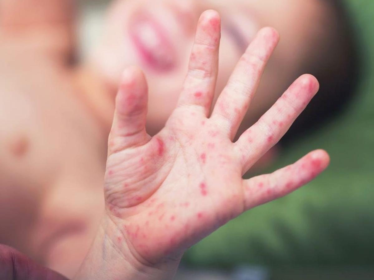 Alerta en Nariño por aumento de casos del virus boca, manos y pies en niños