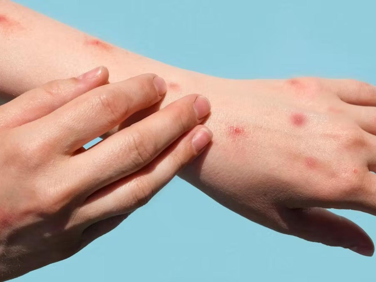 Viruela del mono Colombia: cifras, casos activos, regiones