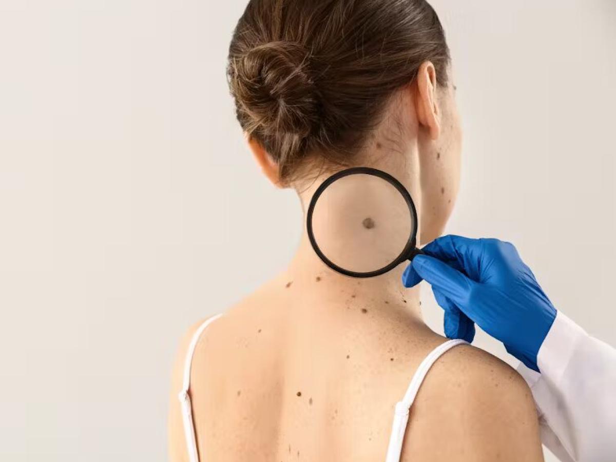 El melanoma: un cáncer duro de pelar