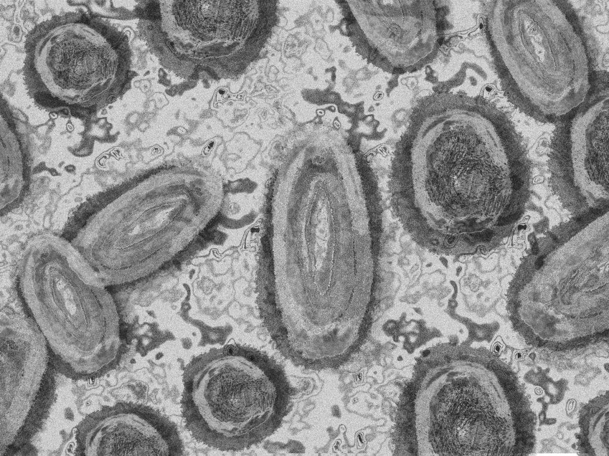 Viruela del mono: confirman primer caso en Valledupar 