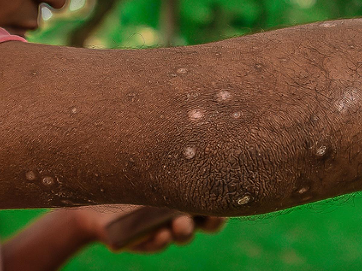 Viruela del Mono: Síntomas, cuidados y tratamientos