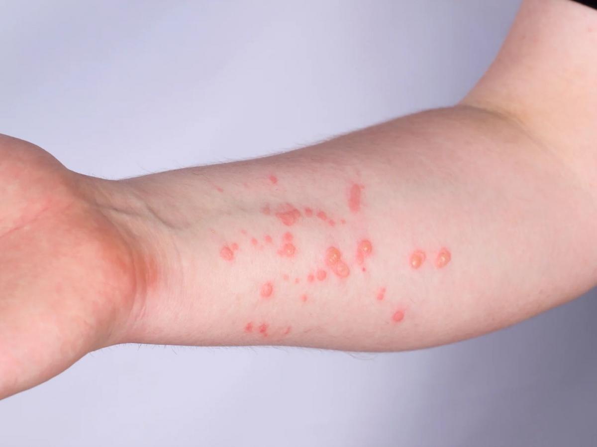 Viruela del mono: cinco casos en Risaralda