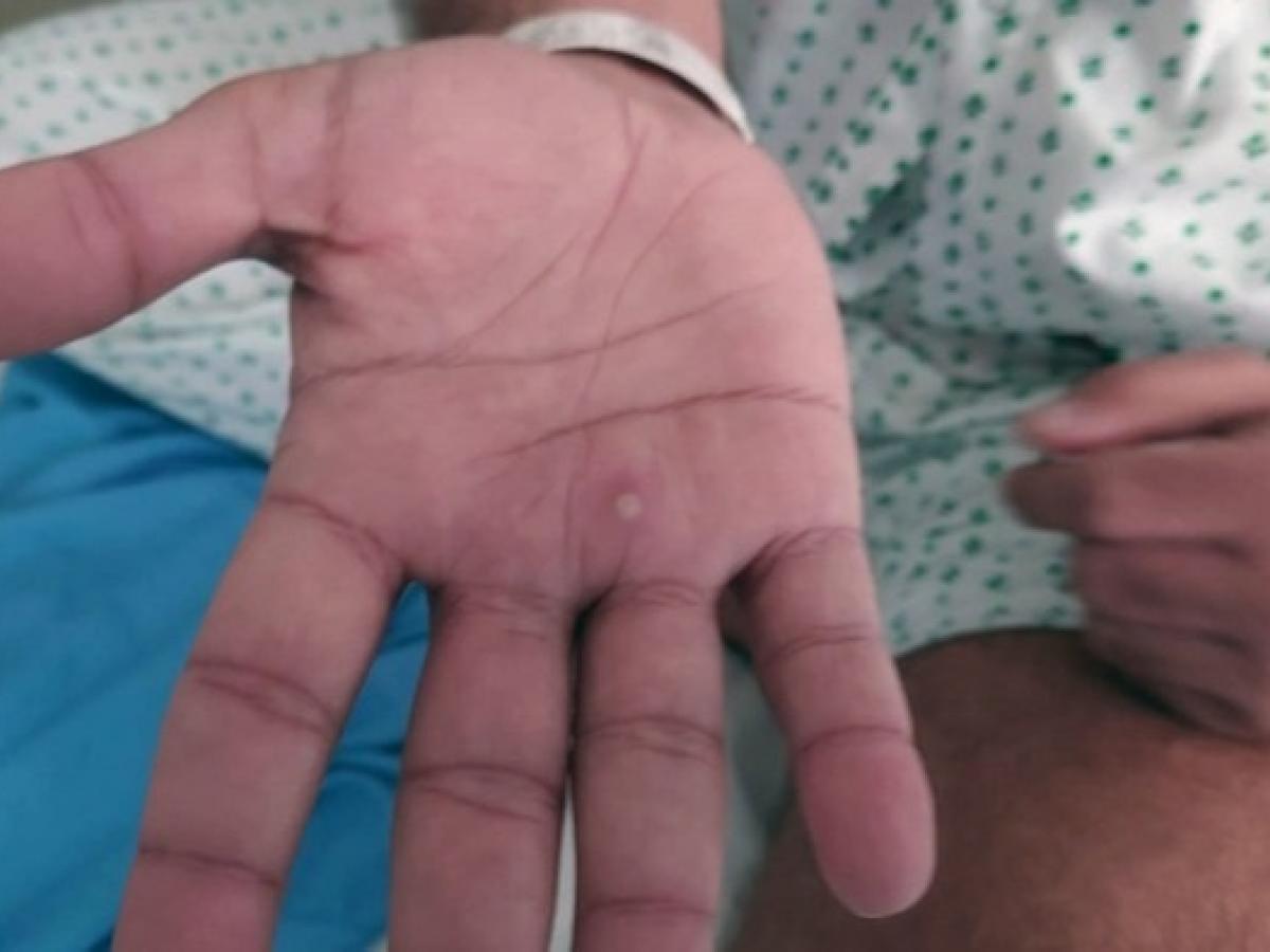 Viruela del mono en Colombia | primer caso en Caldas