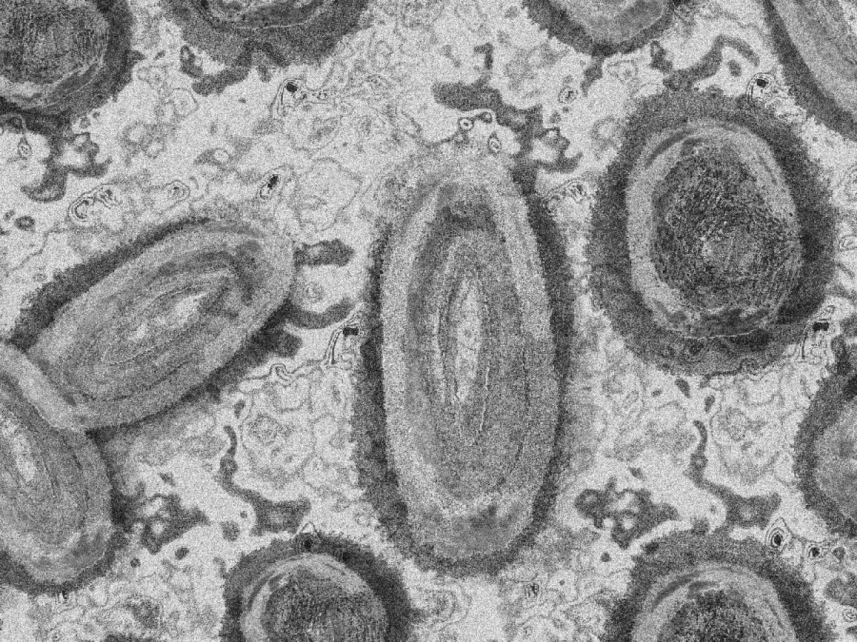 Reportan nuevos casos de la viruela del mono en la Costa Atlántica 