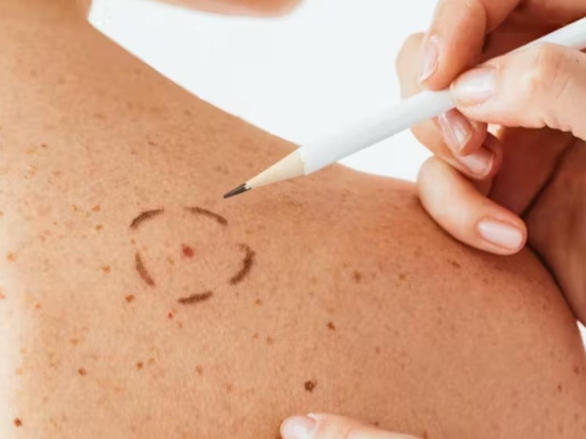 Llegan las vacunas contra el melanoma: ¿cómo funcionan?