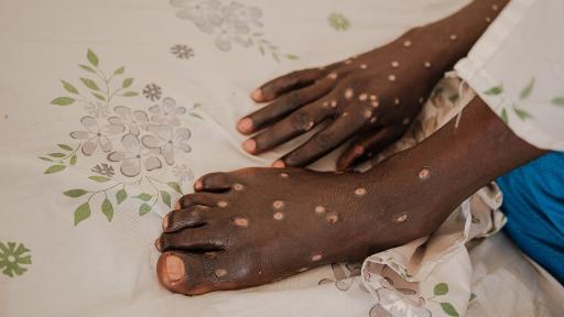 ¿Qué tan peligrosa es la mpox?