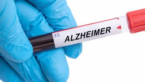 Análisis de sangre para predecir el alzhéimer: comienza una nueva era en la prevención