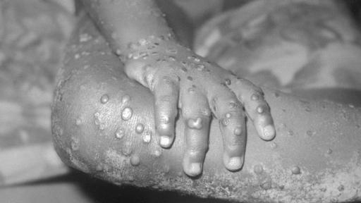 Viruela del mono no es, por el momento, una emergencia sanitaria: OMS