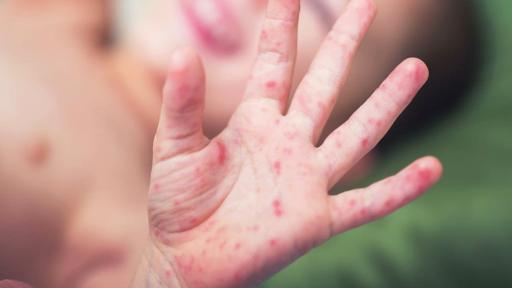 Alerta en Nariño por aumento de casos del virus boca, manos y pies en niños