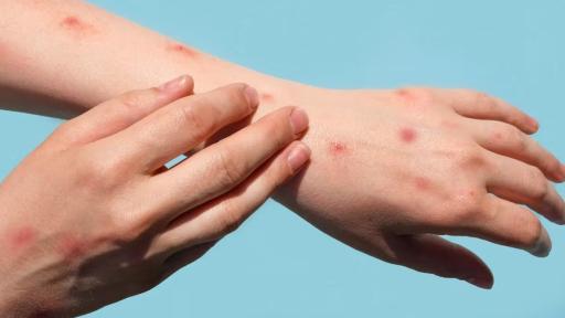 Viruela del mono Colombia: cifras, casos activos, regiones