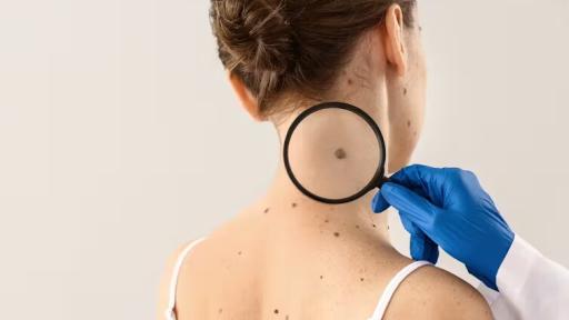 El melanoma: un cáncer duro de pelar