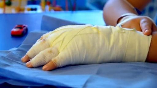 Quemados por pólvora en Colombia aumentaron 10,4 % 