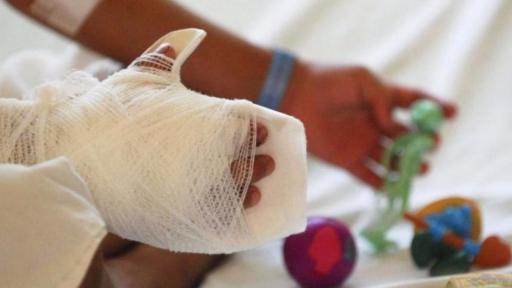 Antioquia: 11 quemados por pólvora en diciembre; Hospital San Vicente alerta
