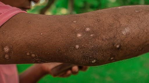 Viruela del Mono: Síntomas, cuidados y tratamientos