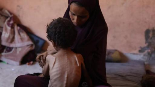 unicef: desnutricion niños gaza