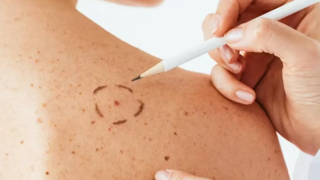 Llegan las vacunas contra el melanoma: ¿cómo funcionan?