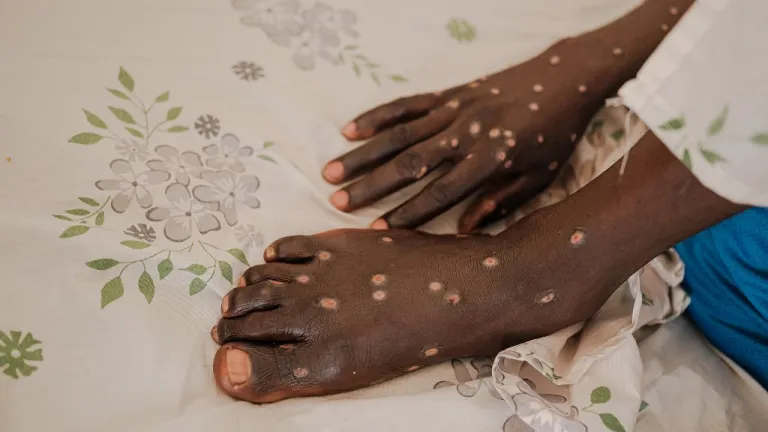 ¿Qué tan peligrosa es la mpox?