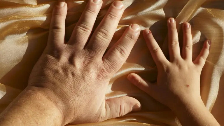 ¿Qué es la acromegalia en el ser humano?
